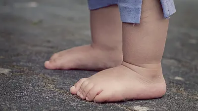 Dziecko stawia stopę do środka - jak wyleczyć?